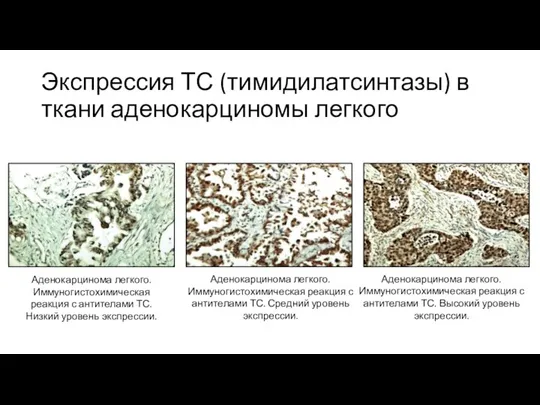 Экспрессия ТС (тимидилатсинтазы) в ткани аденокарциномы легкого Аденокарцинома легкого. Иммуногистохимическая реакция