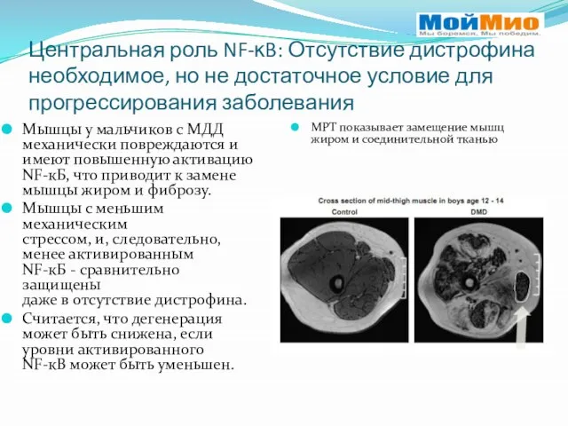 Центральная роль NF-ĸB: Отсутствие дистрофина необходимое, но не достаточное условие для