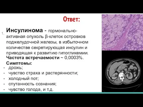 Ответ: 1. Инсулинома - гормонально-активная опухоль β-клеток островков поджелудочной железы, в