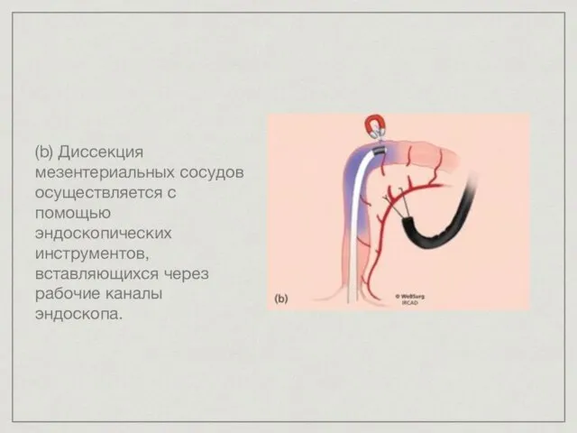 (b) Диссекция мезентериальных сосудов осуществляется с помощью эндоскопических инструментов, вставляющихся через рабочие каналы эндоскопа.