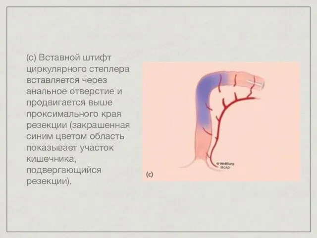 (с) Вставной штифт циркулярного степлера вставляется через анальное отверстие и продвигается