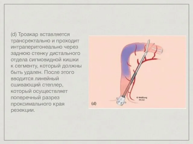 (d) Троакар вставляется трансректально и проходит интраперитонеально через заднюю стенку дистального