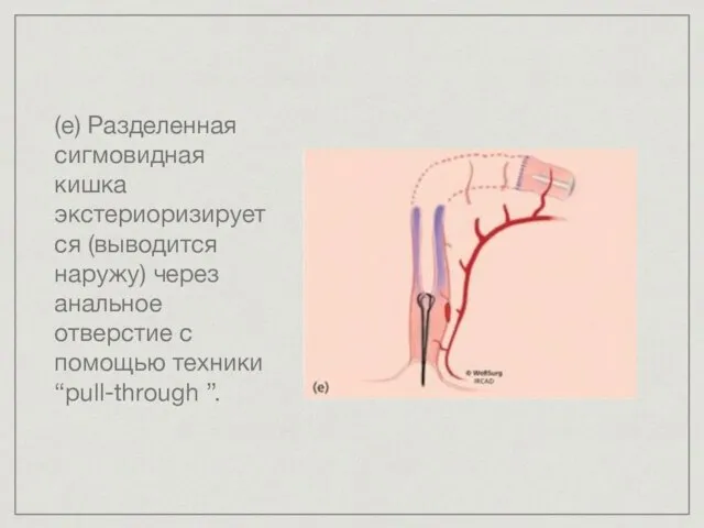 (е) Разделенная сигмовидная кишка экстериоризируется (выводится наружу) через анальное отверстие с помощью техники “pull-through ”.