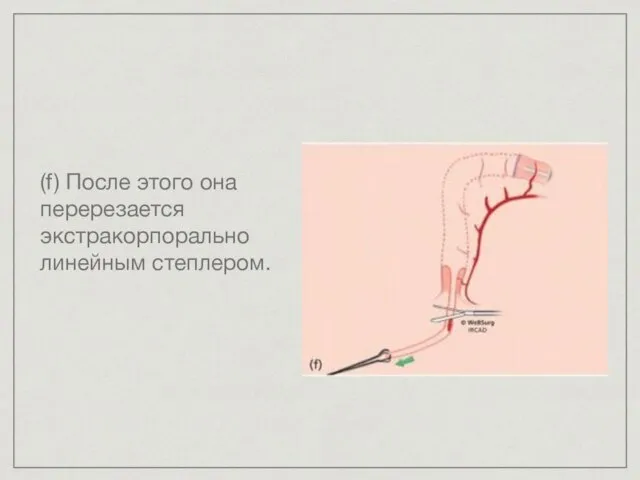 (f) После этого она перерезается экстракорпорально линейным степлером.