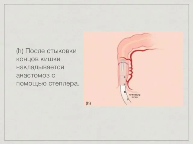 (h) После стыковки концов кишки накладывается анастомоз с помощью степлера.