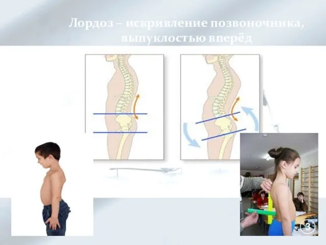 Лордоз – искривление позвоночника, выпуклостью вперёд