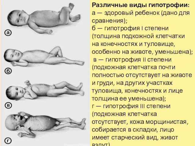 Различные виды гипотрофии: а — здоровый ребенок (дано для сравнения); б