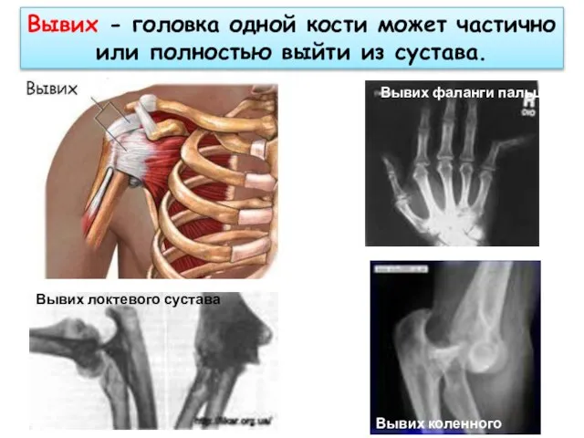 Вывих - головка одной кости может частично или полностью выйти из