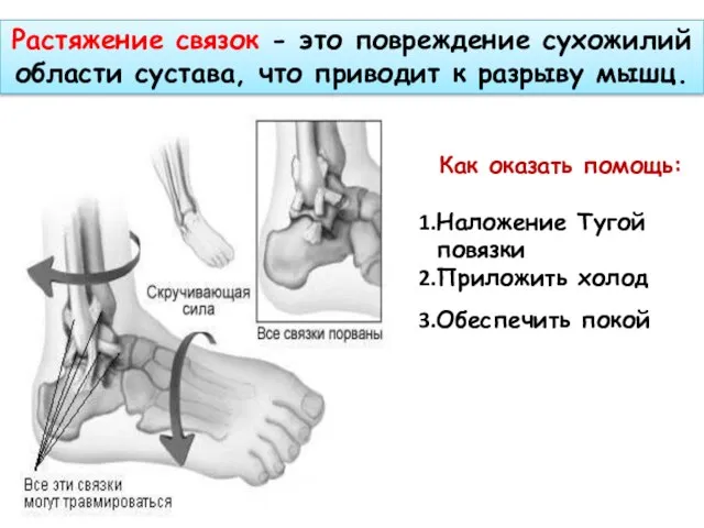 Растяжение связок - это повреждение сухожилий области сустава, что приводит к