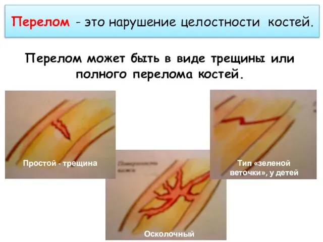 Перелом - это нарушение целостности костей. Перелом может быть в виде