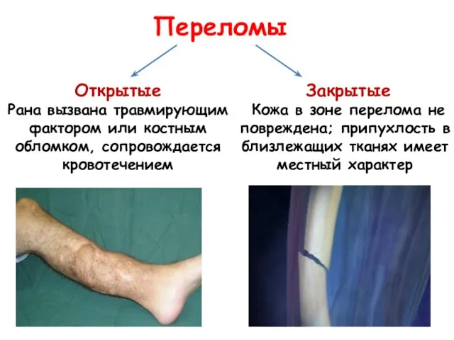 Открытые Рана вызвана травмирующим фактором или костным обломком, сопровождается кровотечением Закрытые