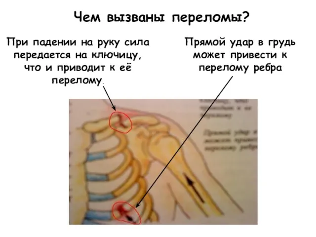 Чем вызваны переломы? При падении на руку сила передается на ключицу,