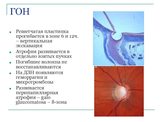 ГОН Решетчатая пластинка прогибается в зоне 6 и 12ч. – вертикальная