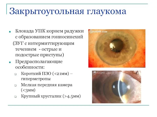 Закрытоугольная глаукома Блокада УПК корнем радужки с образованием гониосинехий (ЗУГ с