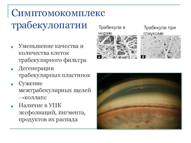 Симптомокомплекс трабекулопатии Уменьшение качества и количества клеток трабекулярного фильтра Дегенерация трабекулярных