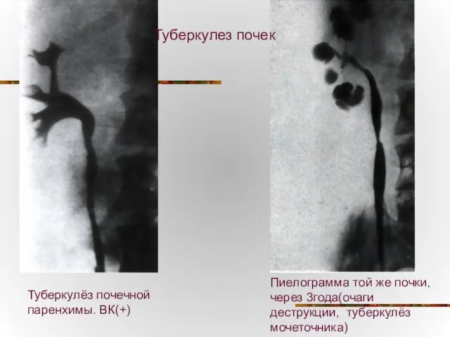 Пиелограмма той же почки,через 3года(очаги деструкции, туберкулёз мочеточника) Туберкулёз почечной паренхимы. ВК(+) Туберкулез почек