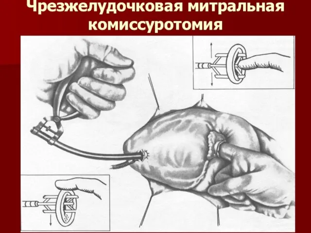 Чрезжелудочковая митральная комиссуротомия