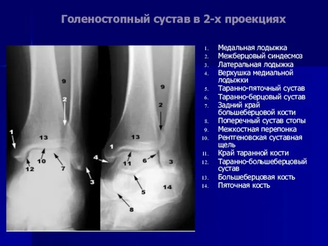 Голеностопный сустав в 2-х проекциях Медальная лодыжка Межберцовый синдесмоз Латеральная лодыжка