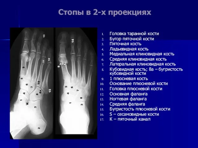 Стопы в 2-х проекциях Головка таранной кости Бугор пяточной кости Пяточная