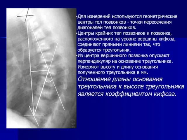 Для измерений используются геометрические центры тел позвонков - точки пересечения диагоналей