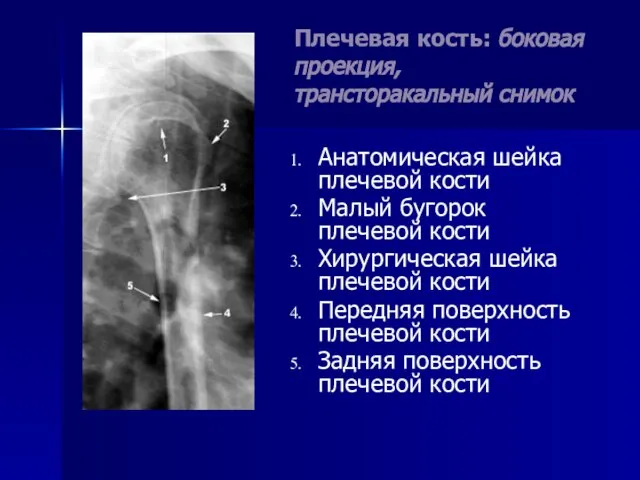 Плечевая кость: боковая проекция, трансторакальный снимок Анатомическая шейка плечевой кости Малый