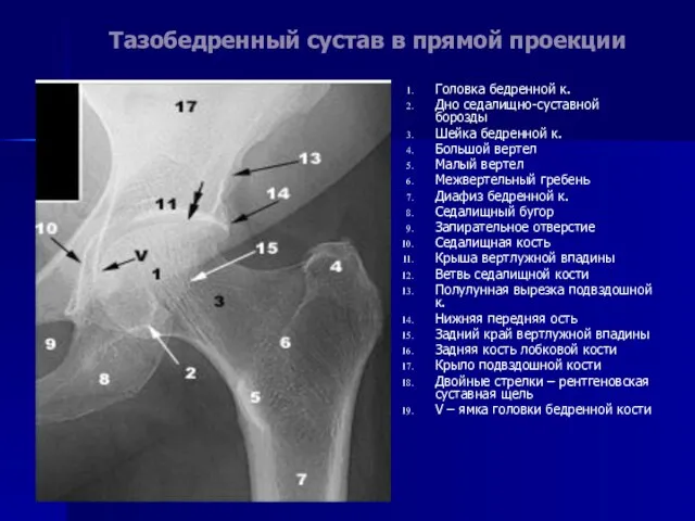 Тазобедренный сустав в прямой проекции Головка бедренной к. Дно седалищно-суставной борозды