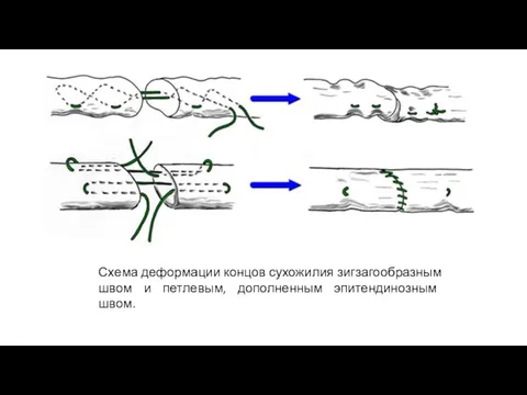 Схема деформации концов сухожилия зигзагообразным швом и петлевым, дополненным эпитендинозным швом.