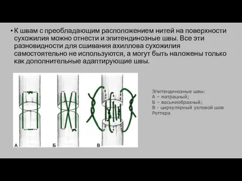 К швам с преобладающим расположением нитей на поверхности сухожилия можно отнести