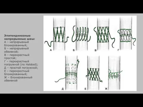Эпитендинозные непрерывные швы: А – непрерывный блокированный; Б – непрерывный обвивной;