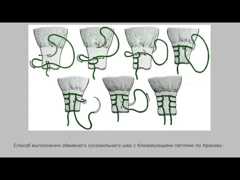 Способ выполнения обвивного сухожильного шва с блокирующими петлями по Кракову.