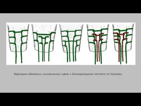 Вариации обвивных сухожильных швов с блокирующими петлями по Кракову.