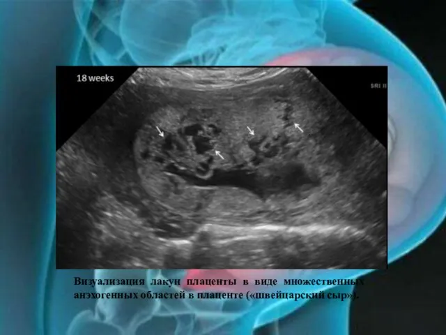 Визуализация лакун плаценты в виде множественных анэхогенных областей в плаценте («швейцарский сыр»).
