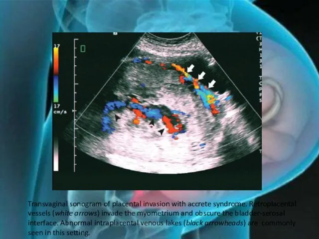 Transvaginal sonogram of placental invasion with accrete syndrome. Retroplacental vessels (white