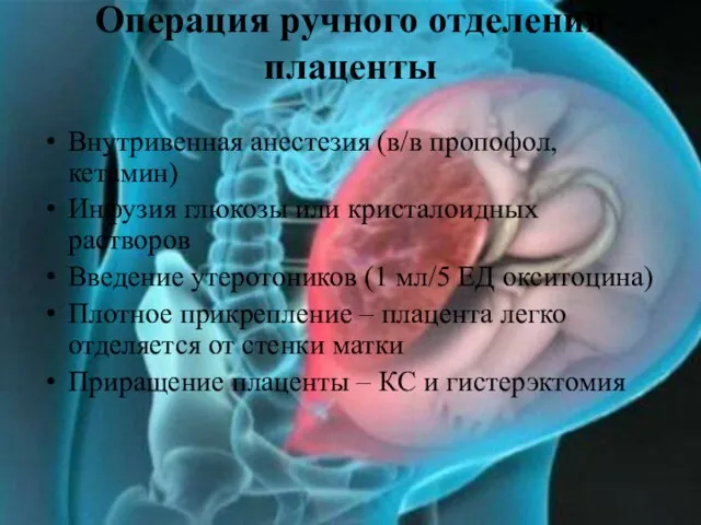 Операция ручного отделения плаценты Внутривенная анестезия (в/в пропофол, кетамин) Инфузия глюкозы