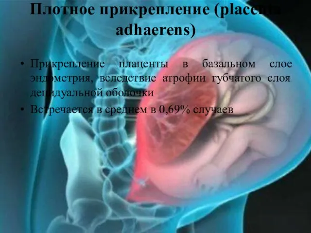 Плотное прикрепление (placenta adhaerens) Прикрепление плаценты в базальном слое эндометрия, вследствие