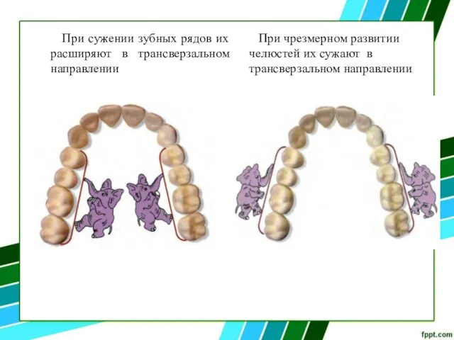 При сужении зубных рядов их расширяют в трансверзальном направлении При чрезмерном