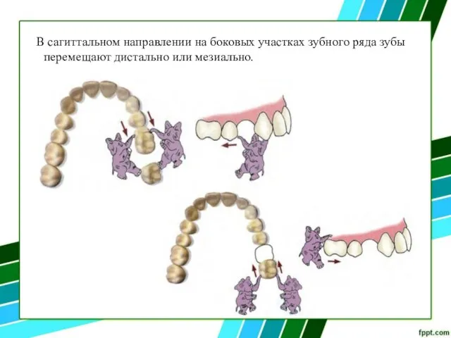 В сагиттальном направлении на боковых участках зубного ряда зубы перемещают дистально или мезиально.