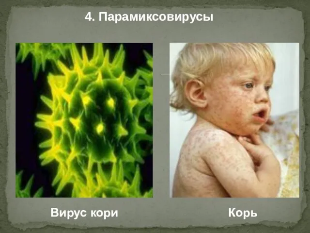 4. Парамиксовирусы Вирус кори Корь