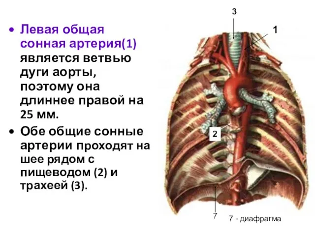 Левая общая сонная артерия(1) является ветвью дуги аорты, поэтому она длиннее