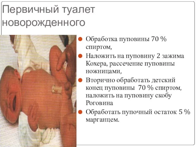 Первичный туалет новорожденного Обработка пуповины 70 % спиртом, Наложить на пуповину