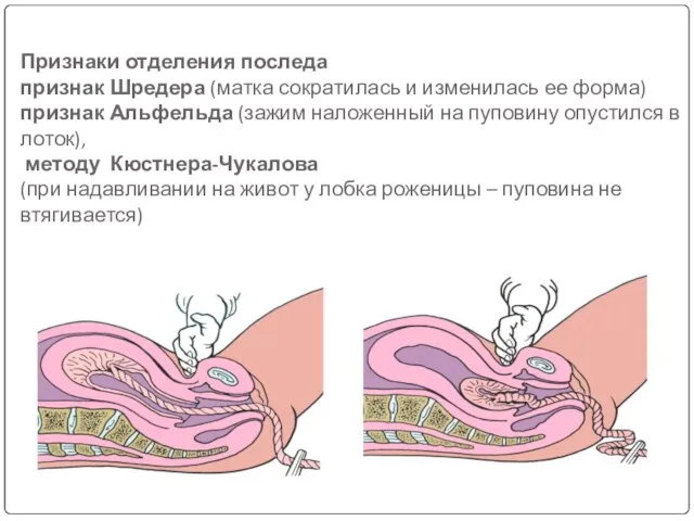 Признаки отделения последа признак Шредера (матка сократилась и изменилась ее форма)