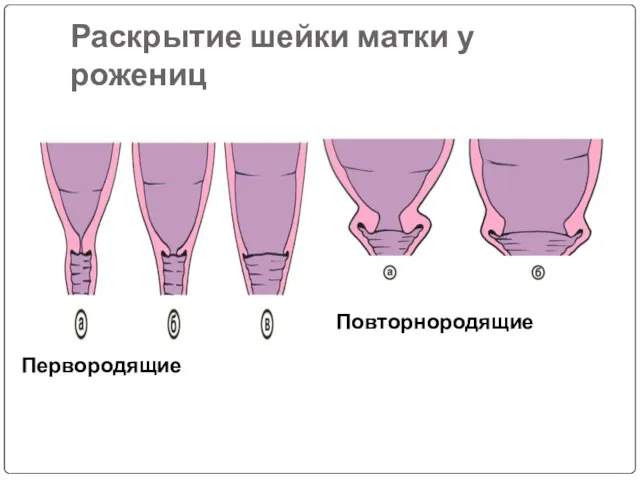 Раскрытие шейки матки у рожениц Первородящие Повторнородящие