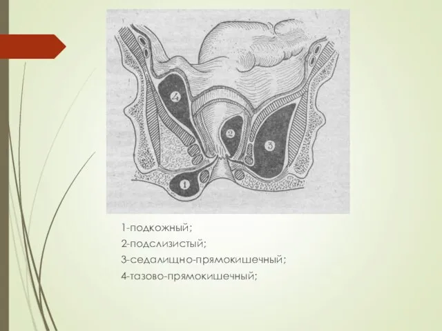 1-подкожный; 2-подслизистый; 3-седалищно-прямокишечный; 4-тазово-прямокишечный;