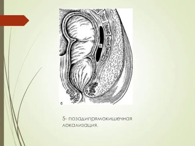 5- позадипрямокишечная локализация.