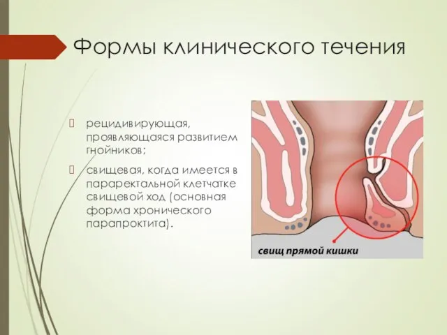 Формы клинического течения рецидивирующая, проявляющаяся развитием гнойников; свищевая, когда имеется в