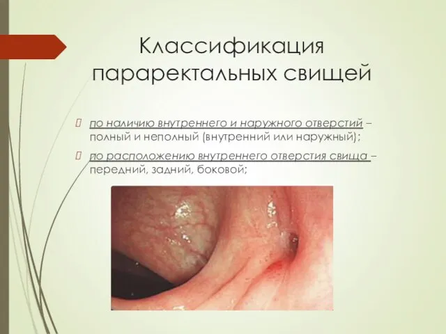 Классификация параректальных свищей по наличию внутреннего и наружного отверстий – полный