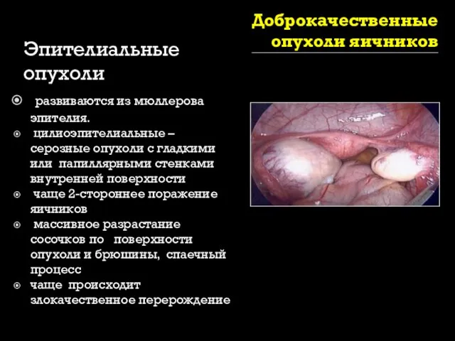 Доброкачественные опухоли яичников Эпителиальные опухоли развиваются из мюллерова эпителия. цилиоэпителиальные –