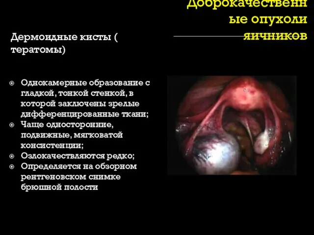 Доброкачественные опухоли яичников Дермоидные кисты ( тератомы) Однокамерные образование с гладкой,