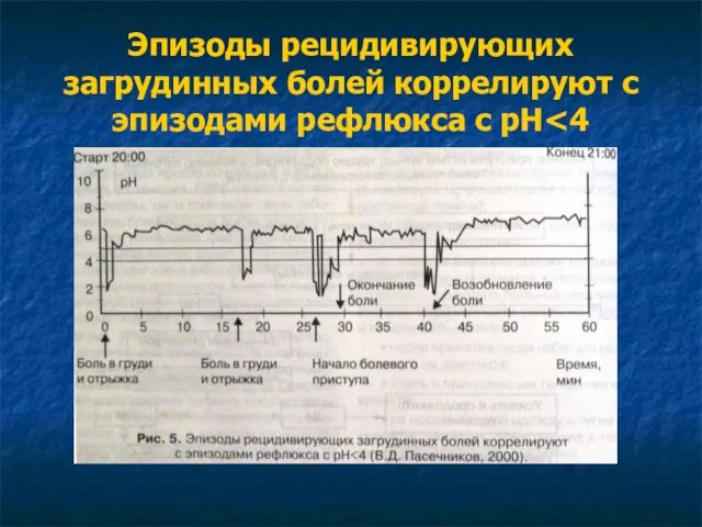 Эпизоды рецидивирующих загрудинных болей коррелируют с эпизодами рефлюкса с рН