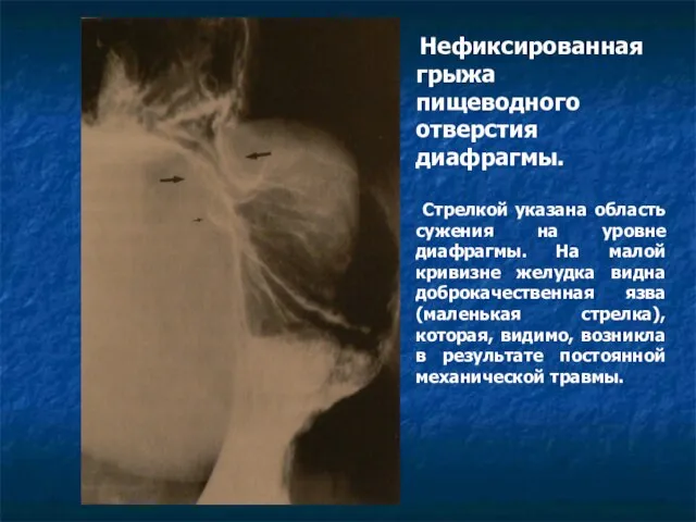 Нефиксированная грыжа пищеводного отверстия диафрагмы. Стрелкой указана область сужения на уровне